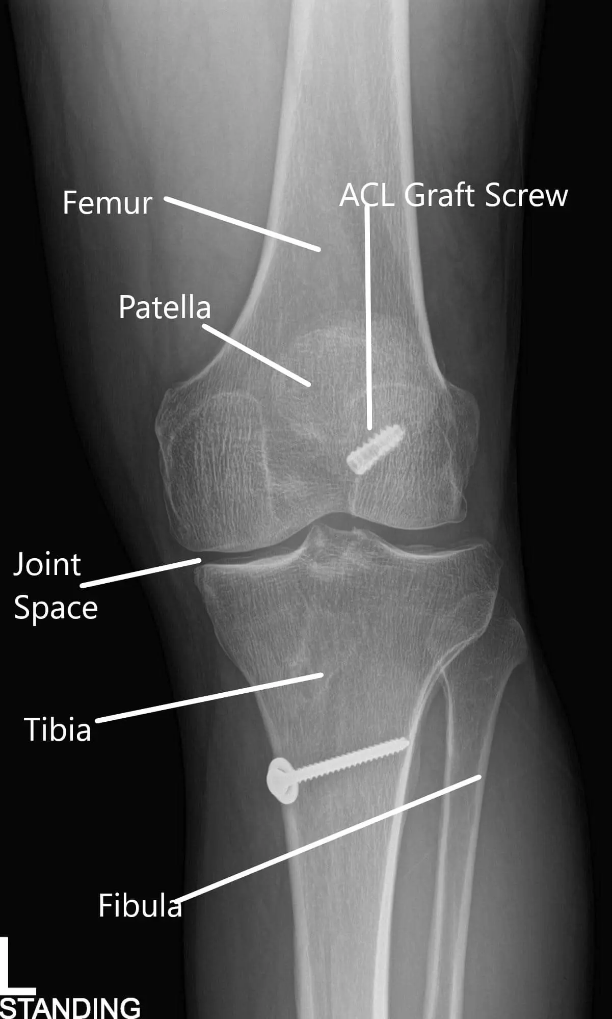 X-ray of the left knee in AP and Lateral views