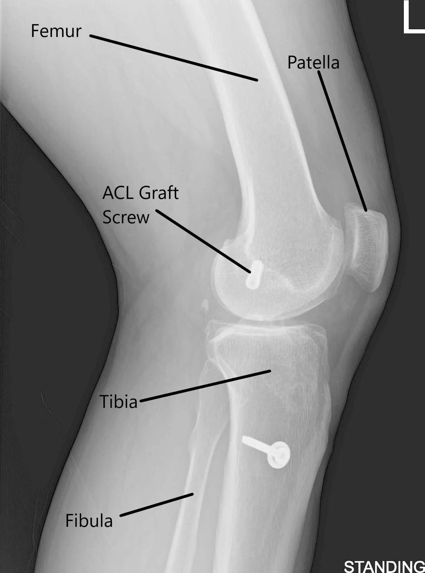 X-ray of the left knee in AP and Lateral views