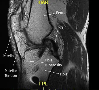 Sagittal MRI view of the left knee 2