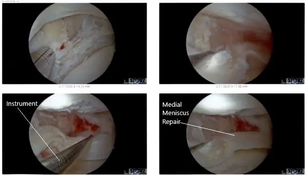 Intraoperative Arthroscopic Views of the left knee 3