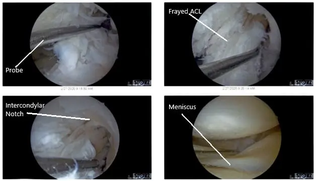 Intraoperative Arthroscopic Views of the left knee 4