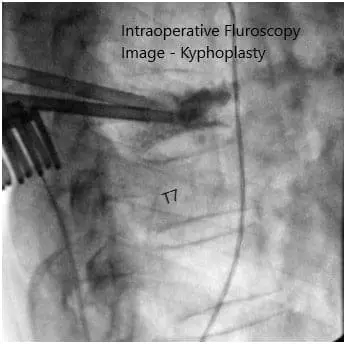 Intraoperative fluoroscopy images 2