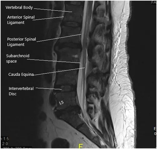 MRI of the lumbosacral spine in sagittal and axial views