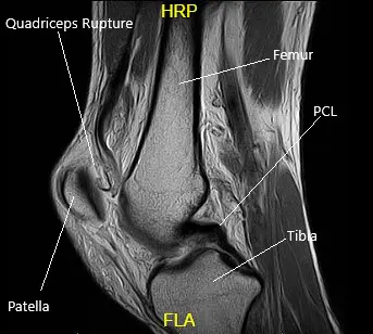 MRI of the Left Knee in the sagittal section