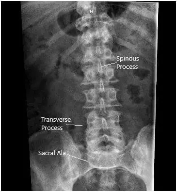 X-ray in AP and Lateral views demonstrated narrowing of the L5-S1 Disc