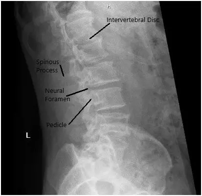 X-ray in AP and Lateral views demonstrated narrowing of the L5-S1 Disc 2