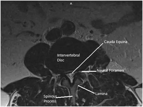 MRI of the Lumbosacral spine in sagittal and axial sections 2