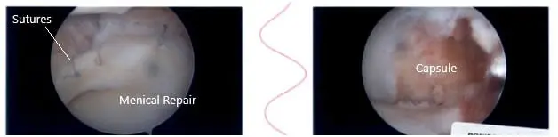 Intraoperative knee arthroscopic images 2