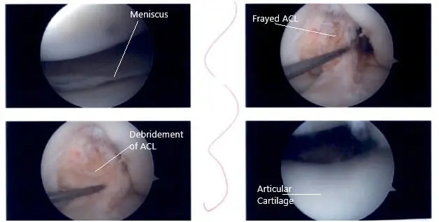 Intraoperative knee arthroscopic images 3