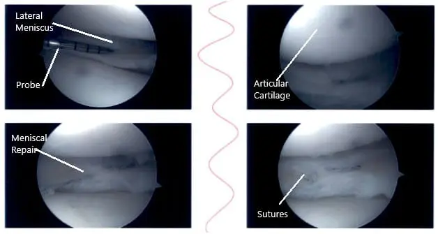 Intraoperative knee arthroscopic images 4