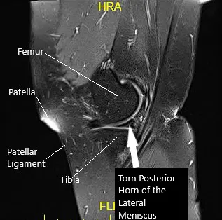Sagittal MRI image of the left knee