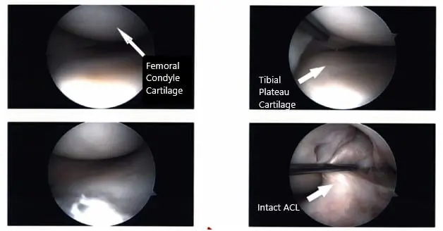 Intraoperative Arthroscopic images of the left knee 2