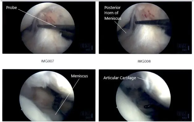 Intraoperative Arthroscopic Images of the right knee