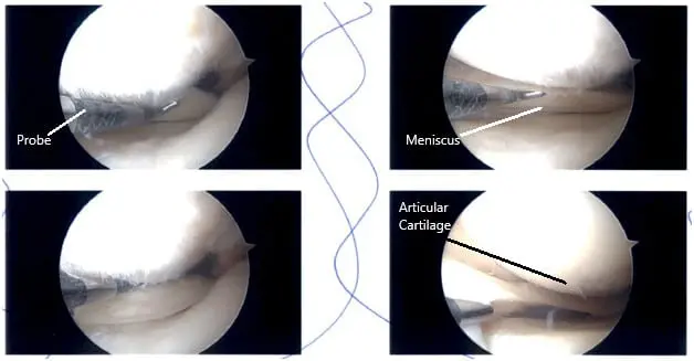 Intraoperative Arthroscopy images