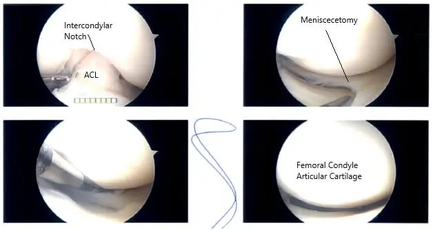 Intraoperative Arthroscopy images 2