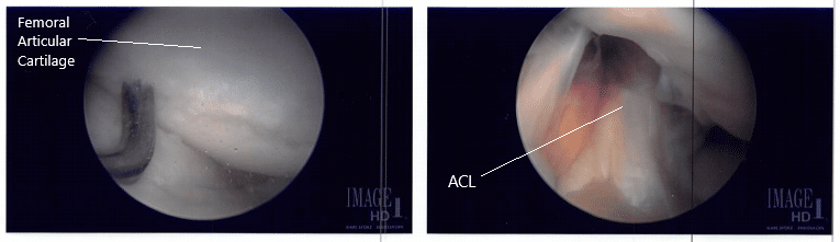 Intraoperative arthroscope images 3