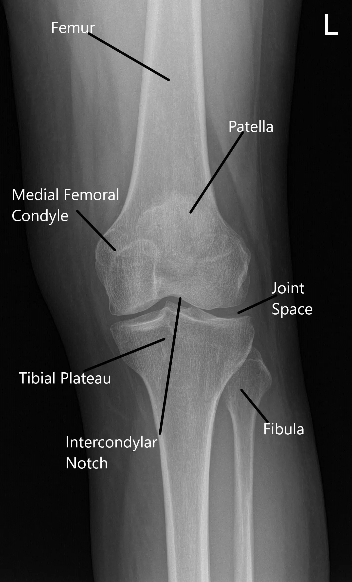 Normal X-ray of the knee joint showing the various structures in the Anteroposterior and Lateral view