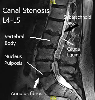 MRI of the lumbar spine