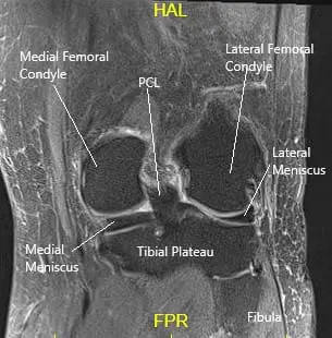 MRI of the knee in the coronal section showing various structures