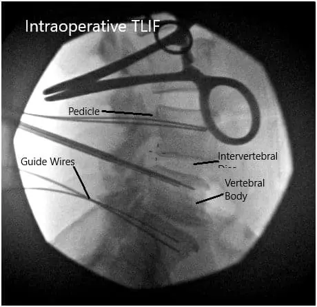 Intraoperative Fluoroscopic Images