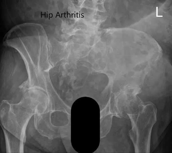 Preoperative X-ray showing the frog-legged lateral and AP view of the left hip 2