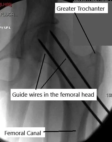 Guidewires passed to the femoral head. Guidewires passed to the femoral head.
