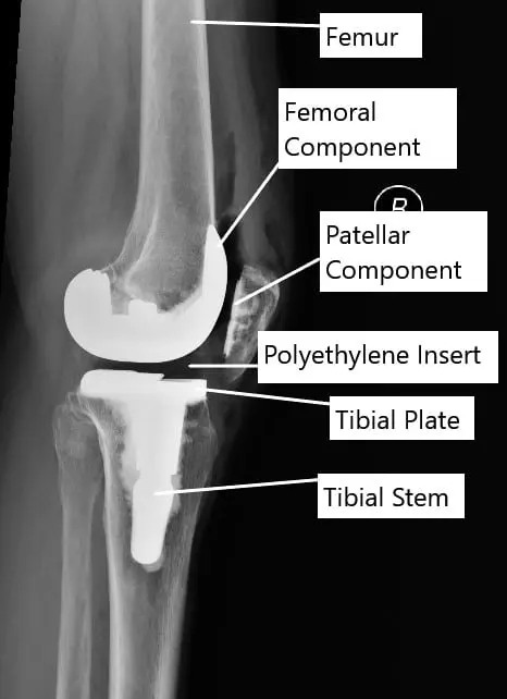 Total Knee Replacement