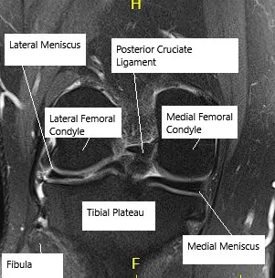 MRI showing knee meniscus.