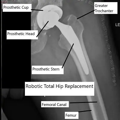 Robotic Hip Replacement