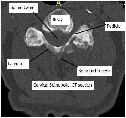 Cervical CT scan showing axial section.