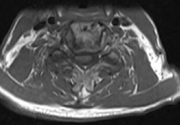 MRI T2 image Axial cut showing severe spinal cord stenosis and compression at C3-4 2