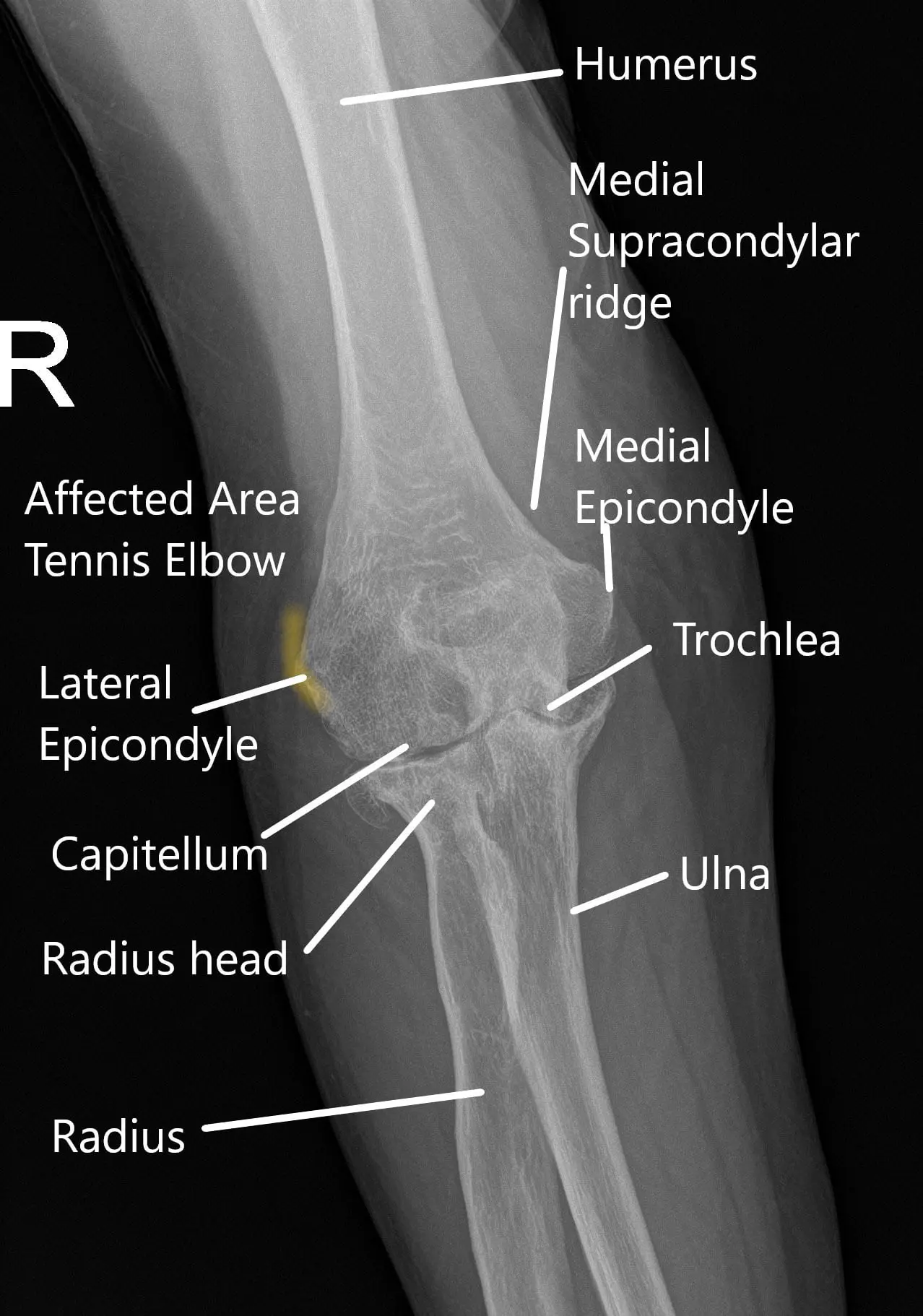 X-ray of the elbow in the AP view.