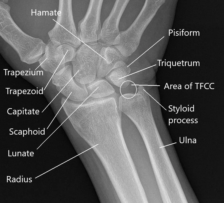 X-ray of the wrist showing anatomy of the wrist.