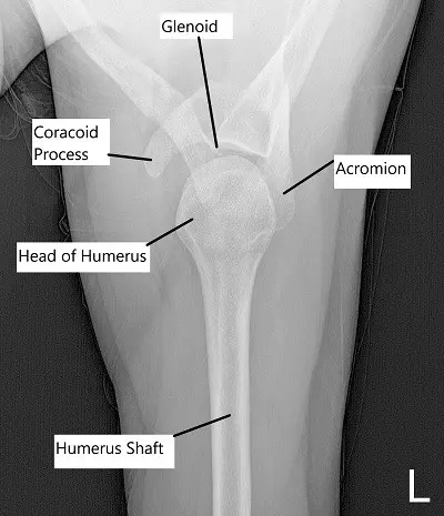 Anteroposterior view of Left Shoulder.