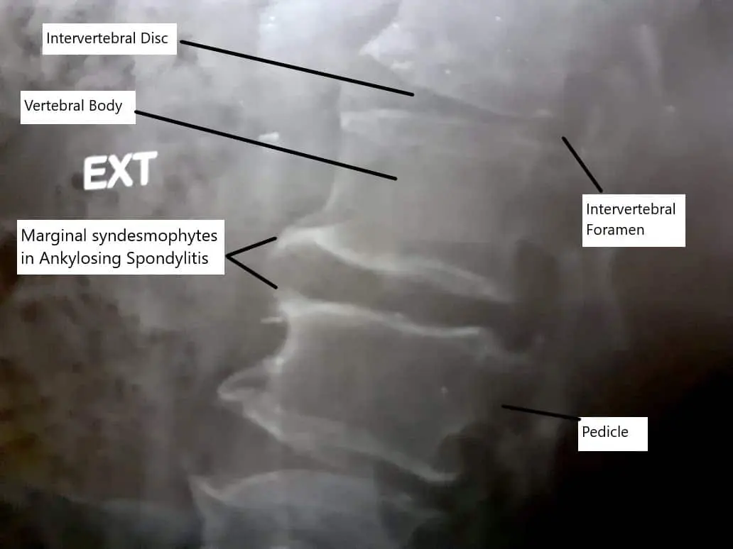 Syndesmophytes in Ankylosing Spondylitis