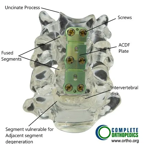 Bone model showing ACDF.