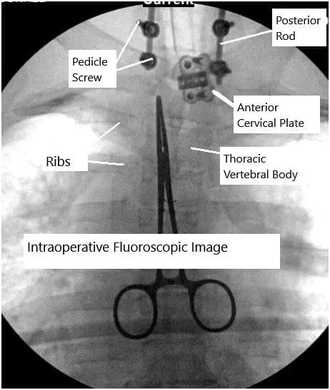 Combined anterior and posterior cervical spine surgery.