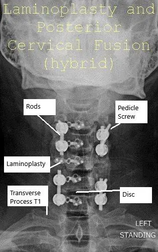 AP and Lateral view X-ray Post-op Laminoplasty and Posterior Spinal Fusion
