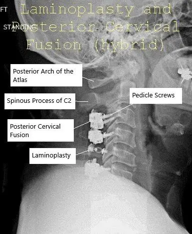 AP and Lateral view X-ray Post-op Laminoplasty and Posterior Spinal Fusion