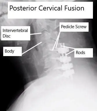 AP and Lateral View X-rays of Posterior Cervical Laminectomy and Fusion