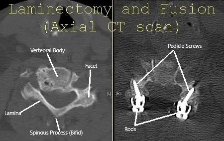 Cervical Spine Axial CT scan showing Laminectomy and fusion.