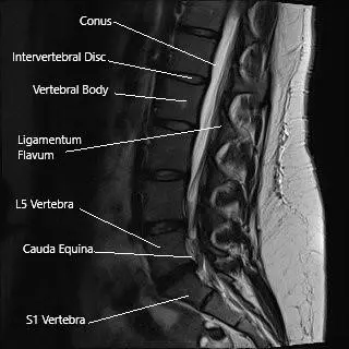 Sagittal section of the lumbosacral spine on MRI.