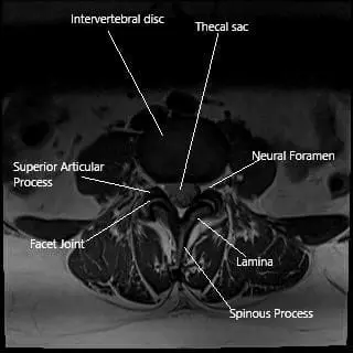 MRI axial section showing the facet joint.