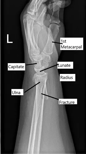 X-ray showing distal radius fracture in lateral view.