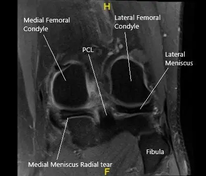 MRI of the left knee in the coronal section showing the torn medial meniscus.