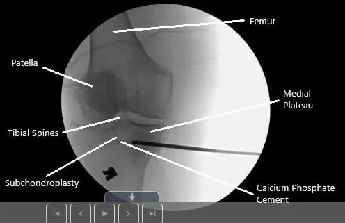Intraoperative fluoroscopic image of subchondroplasty.