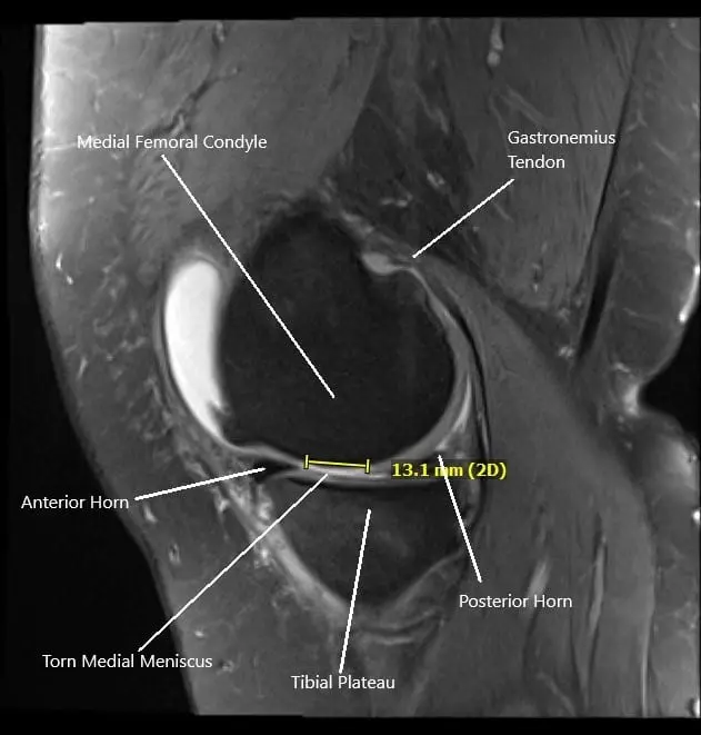MRI of the right knee in sagittal section showing tear of the medial meniscus.