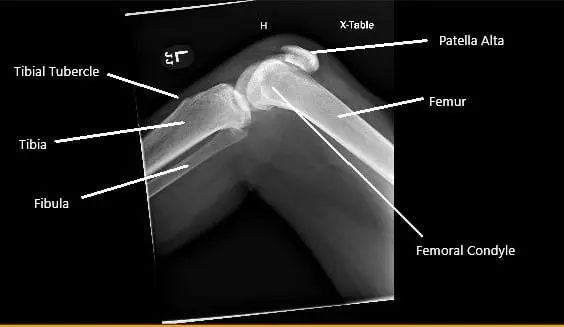 X-ray of the right knee showing patella Alta secondary to the rupture of the patellar tendon.