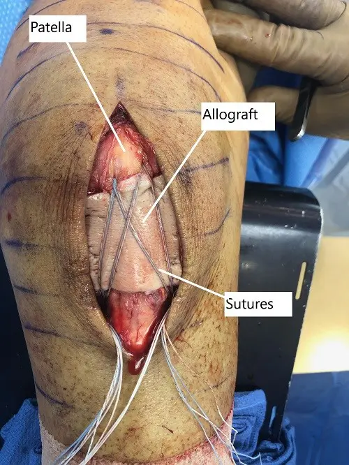 Intraoperative image showing the repaired patellar tendon with overlying allograft.