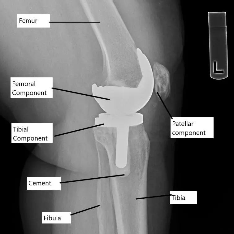 X-ray showing a total knee replacement.